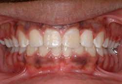 front-Intraoral-Photo-2-2014.jpg